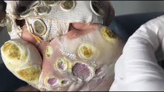 Plantar Wart  Its scary I havent seen it before  pedicure no pain  Mr specialist  epi 12 [upl. by Noied]