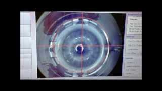 LASIK 100 laser with custom elliptical flap for astigmatism correction [upl. by Yenitsed]