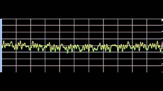 Raynauds Disease  Rife Frequencies [upl. by Aneeuqahs]