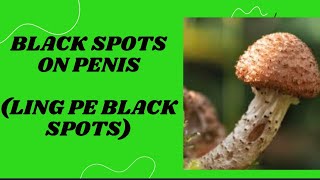 लिंग पे काले दाने । black spots on penis  melanosis [upl. by Corbett]