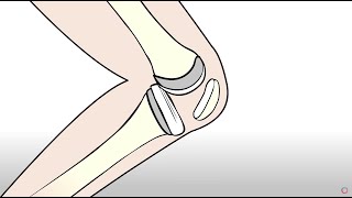 Knee Replacement vs Regenexx Orthopedic Regenerative Treatment [upl. by Eelynnhoj]