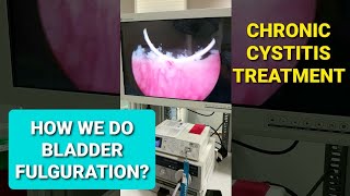 Urinary Tract Infection Chronic Recurrent Cystitis Treatment BLADDER FULGURATION [upl. by Nonnag]