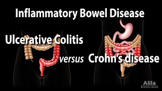 Ulcerative Colitis versus Crohns Disease Animation [upl. by Onia]