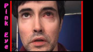 Severe Bacterial Pink Eye Conjunctivitis treatment part 2 [upl. by Moriarty]