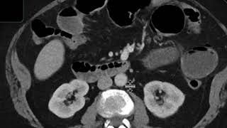 Gallstone ileus [upl. by Gabor715]