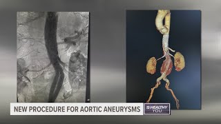 West Michigan man has new procedure to treat aortic aneurysm first in state [upl. by Ahsehyt539]