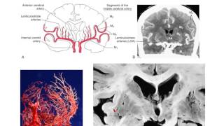 The lenticulostriate vessels and lacunar infarcts [upl. by Gnoz]