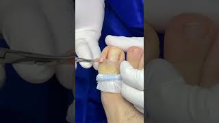 Cauterización de uña ingrowntoenailsurgery satisfying onicocriptosis [upl. by Heall815]