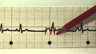 EKG für Pflege Teil 17  Supraventrikuläre Extrasystolen interpretieren SVES [upl. by Asiled]