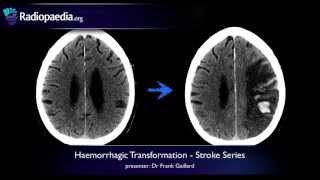 Stroke Haemorrhagic transformation  radiology video tutorial CT MRI [upl. by Ettennahs]