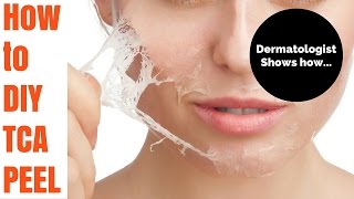 How to TCA peel Tutorial by Dermatologist [upl. by Sherm]