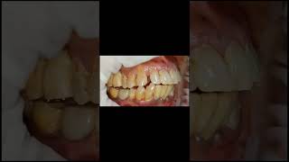 Flat occlusal contour for implant molar crown for generalised attrited dentition shorts [upl. by Nosittam]