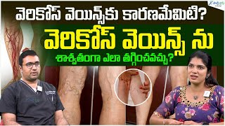 Best Varicose Vein Home Remedies  Get rid of Varicose veins in Telugu  DrViswanath  Sakshi Life [upl. by Ayotan372]