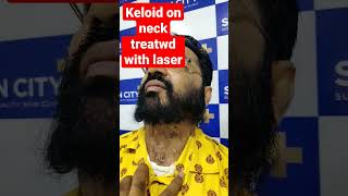 keloid laser treatment at SkinCity l Dr Dhepe l keloid specialist [upl. by Nelleeus]