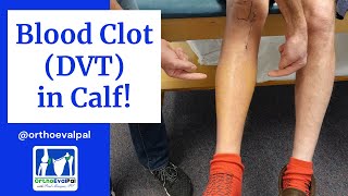 Blood Clot DVT in the Calf Actual Patient Presentation [upl. by Evelin]