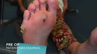 Wound Care The Role of Podiatrist [upl. by Eentruoc]