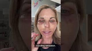 My Advanced Facelift Recovery Day by Day  Real Stories By Real Patients 2022 [upl. by Aihsa]