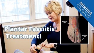 Plantar Fasciitis Pain GONE One Day after Acupuncture [upl. by Alwin]