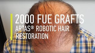 Hair transplant 2000 FUE Grafts ARTAS® Robotic Hair Restoration  Hair By Dr Max [upl. by Gniliem]