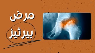 نخر عظام الفخذ فى الاطفالداء ليغ كالفيه بيرثيز  Perthes disease [upl. by Stokes]