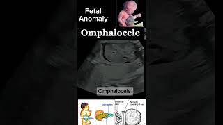 Prenatal Imaging of Omphalocele A Detailed Case Study casestudy anomally shorts DrSaimakhan [upl. by Aneerbas]