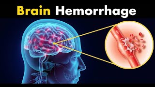 Brain Bleed Hemorrhage Intracranial Hemorrhage Pathology  Etiology Diagnosis amp Treatment [upl. by Onilegna]