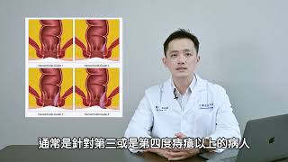 【盧延榕醫師】雷射痔瘡消融手術衛教影片｜Laser Hemorrhoidoplasty [upl. by Atined121]