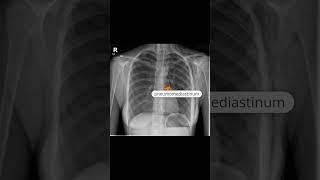 Pneumomediastinum and subcutaneous emphysema [upl. by Dnalro]