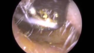 191 BEATING Eardrum visible after simple Ear Wax Removal  Mr Neel Raithatha The Hear Clinic [upl. by Liberati]