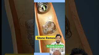 Endoscopic Lithotripsy l Dr Vivek Khetwal shorts stone [upl. by Bendite]