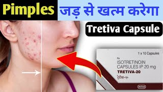 How to remove Pimples  Tretiva 20 Tablet Uses  Acne Treatment [upl. by Galanti]