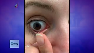 Why Eye Mucus Removal Videos are Popular on TikTok [upl. by Malca]