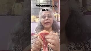 Adenomyosis of uterus health इनफॉर्मेशन [upl. by Thomasa]