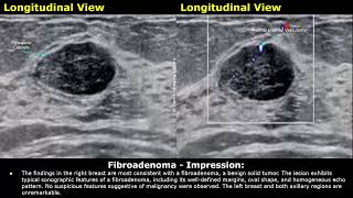 Fibroadenoma Breast Ultrasound Report Example  Benign Tumors USG Scan Report Findings amp Impression [upl. by Osnofledi]