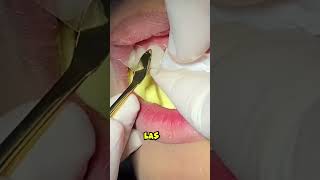 El blanqueamiento dental no es para todos dientes dentista tips parati viral fyp shorts [upl. by Yeloc]