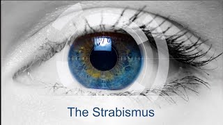 The Strabismus 4  HeteroTropia Amblyopia  Squint management [upl. by Isawk]