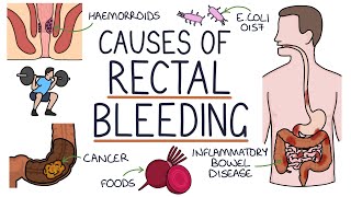 Understanding the Causes of Blood in Stool Rectal Bleeding [upl. by Vaas]