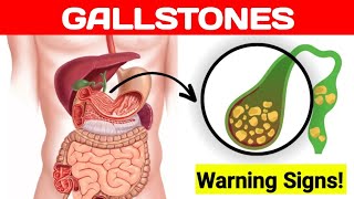 Gallstones Warning Signs amp Symptoms  Cholelithiasis  Health Flavour [upl. by Harden921]