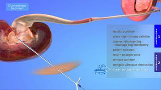 ReSolve ConvertX® Nephroureteral Stent System Introduction [upl. by Nedyah388]