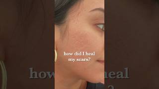 Healing my acne scars before and after results [upl. by Nodnalb]