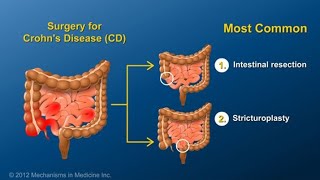 Fabrizio Michelassi Il trattamento chirurgico della malattia di Crohn Le resezioni e le plastiche [upl. by O'Shee41]