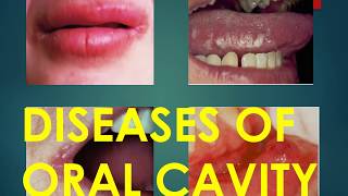 COMMON DISEASES OF ORAL CAVITY I Dental Guide I Dr Bimal Chand I [upl. by Aerdnael]