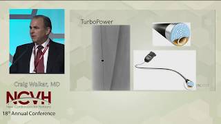 New Tools in Laser Atherectomy Spectranetics Laser [upl. by Julia283]