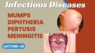 PSM Lecture26  Infectious Diseases Mumps Diphtheria Pertusis Meningococcal Meningitis [upl. by Tohcnarf150]