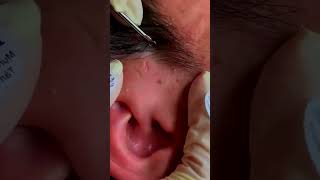 blackhead removal acne blackhead blackremoval [upl. by Eiknarf406]