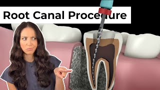 Root Canal Procedure Step by Step [upl. by Nnayt]