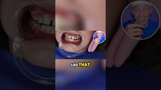 The Process of Getting Braces [upl. by Nehte]