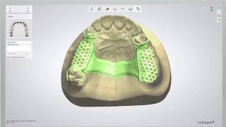 Removable Partial Denture Design Revision part1 [upl. by Jarrow]