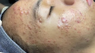 ACNE TREATMENT VU QUYNH MI  Perennial Blackheads On Boy Face 2024FULL [upl. by Piselli]