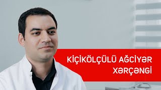 Kiçikölçülü ağciyər xərçəngi  Torakal cərrah UzmDr Nurlan Əlizadə [upl. by Nylirac221]